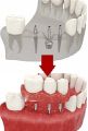 Базальные импланты зубов.jpg
